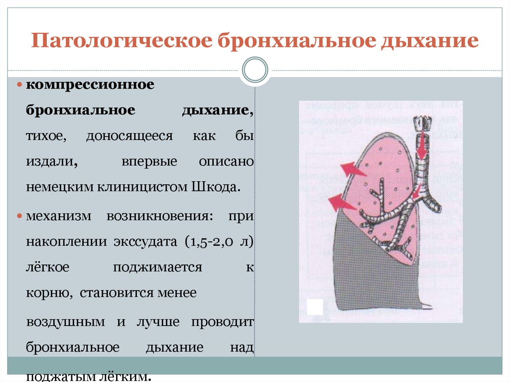 Бронхиальное дыхание. Компрессионное бронхиальное дыхание. Компрессионный вариант патологического бронхиального дыхания. Патологическое бронхиальное дыхание. Механизм возникновения патологического бронхиального дыхания.