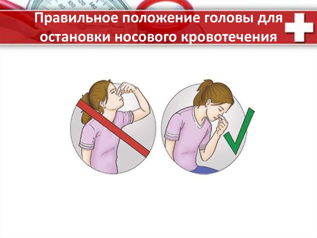 Какое положение при носовом кровотечении. Правильное положение головы для остановки носового кровотечения. Способы остановки кровотечения из носа. Методика остановки носового кровотечения. Способы остановки носового кровотечения.