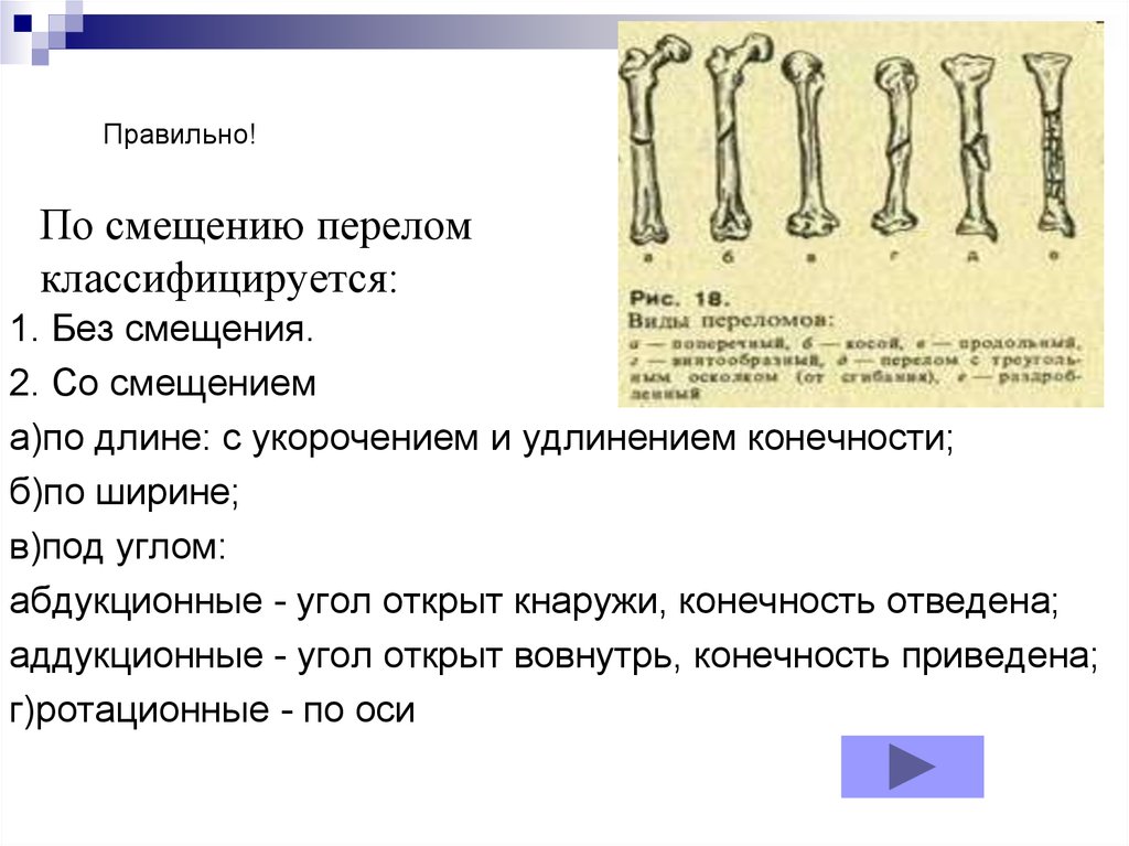 Сколько перелом. Переломы по характеру смещения. Без смещения отломков закрытый перелом.