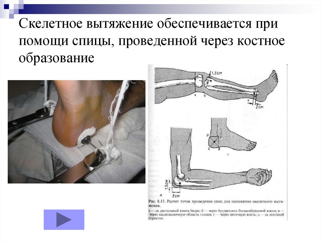 Как вставляют спицы при переломе. Вытяжение при переломе большеберцовой кости. Скелетное вытяжение перелома большеберцовой кости. Спица Киршнера скелетное вытяжение. Вытяжение кости при переломе голени.