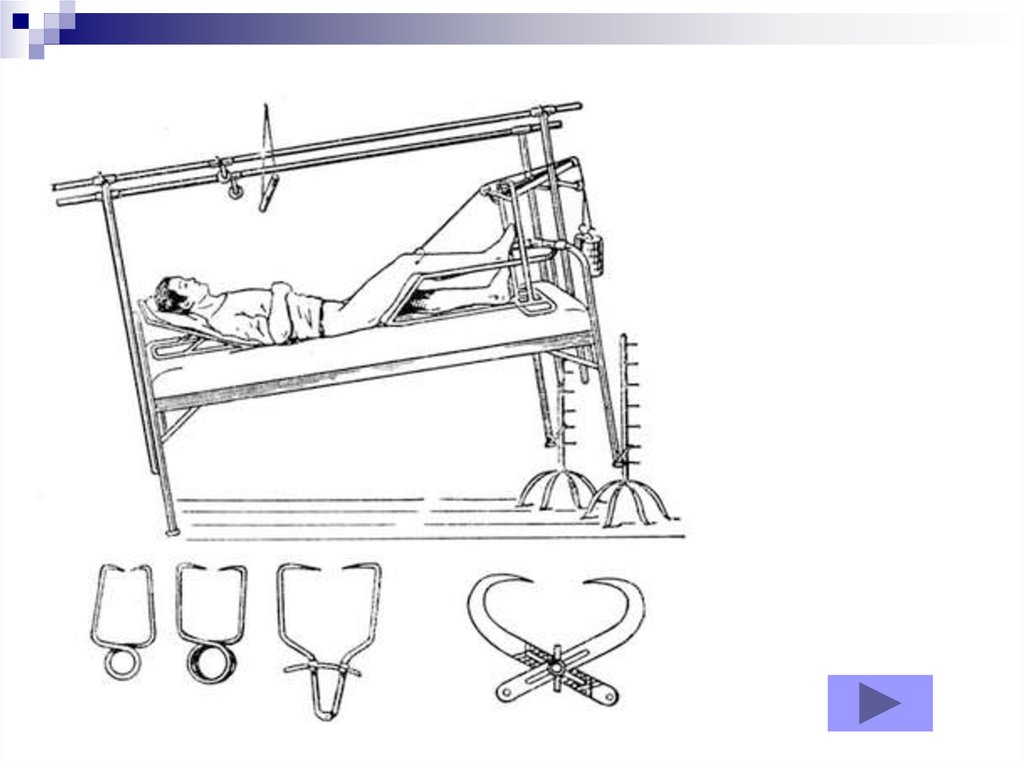 Вытяжение голени. Перелом бедра скелетное вытяжение. Липкопластырное вытяжение при переломе. Вытяжение костных отломков. Скелетное вытяжение большеберцовой кости.