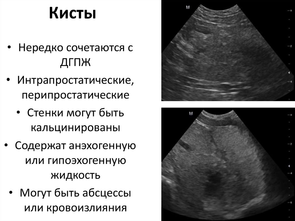 Киста простаты фото узи