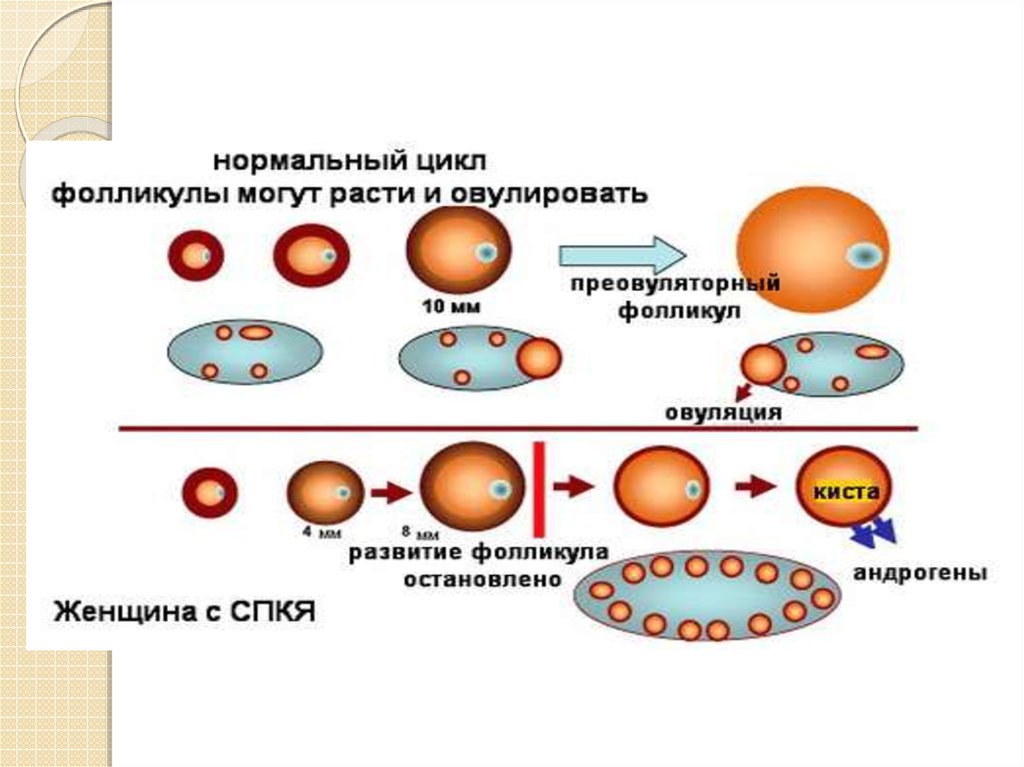 Нормальный цикл. Патогенез поликистоза яичников. Поликистоз яичников этиология. СПКЯ этиология. Патогенез поликистоза яичников схема.