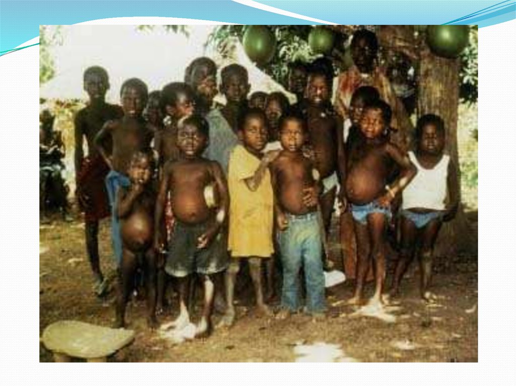 Ветка с голодом клуб. Африканские дети пухнут от голода. Африканские дети с животами.