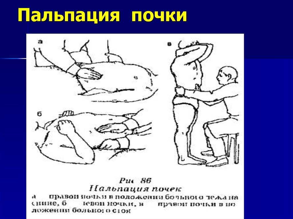 Пальпировать. Методика пальпации почек. Пальпация почек пропедевтика. Методика пальпации почек у детей. Пальпация и перкуссия почек.