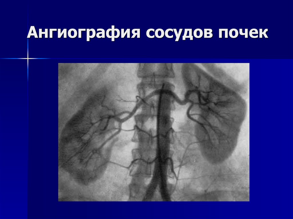 Почечная ангиография презентация