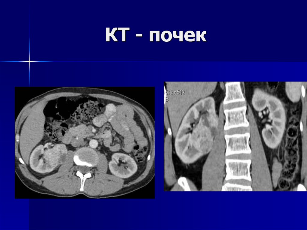 Кт с контрастом что это. Компьютерная рентгеновская томография почек. Контрастирование почек кт. Кт почек с контрастированием кт. Кт почек с контрастированием норма.