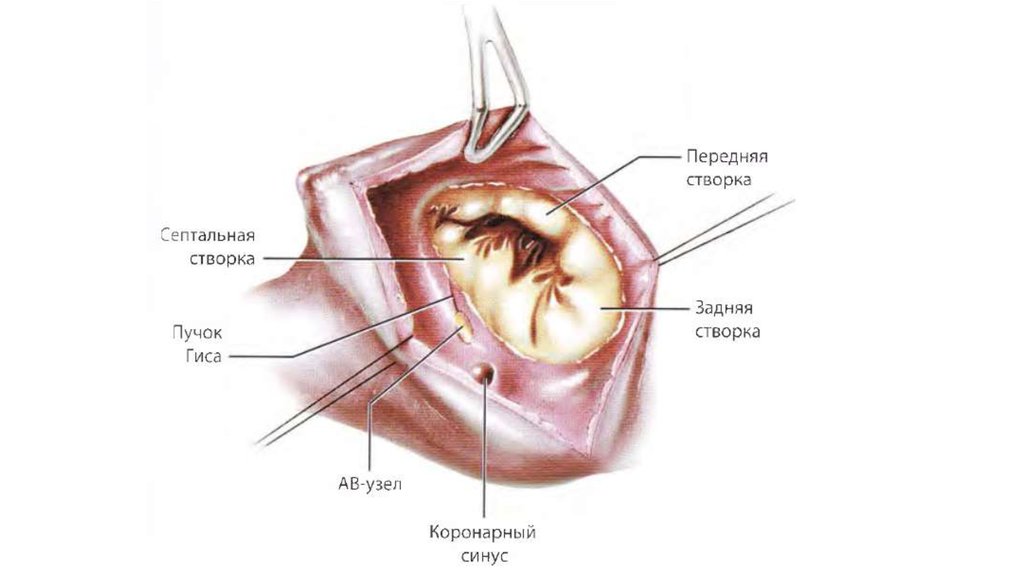 Пластика трикуспидального клапана