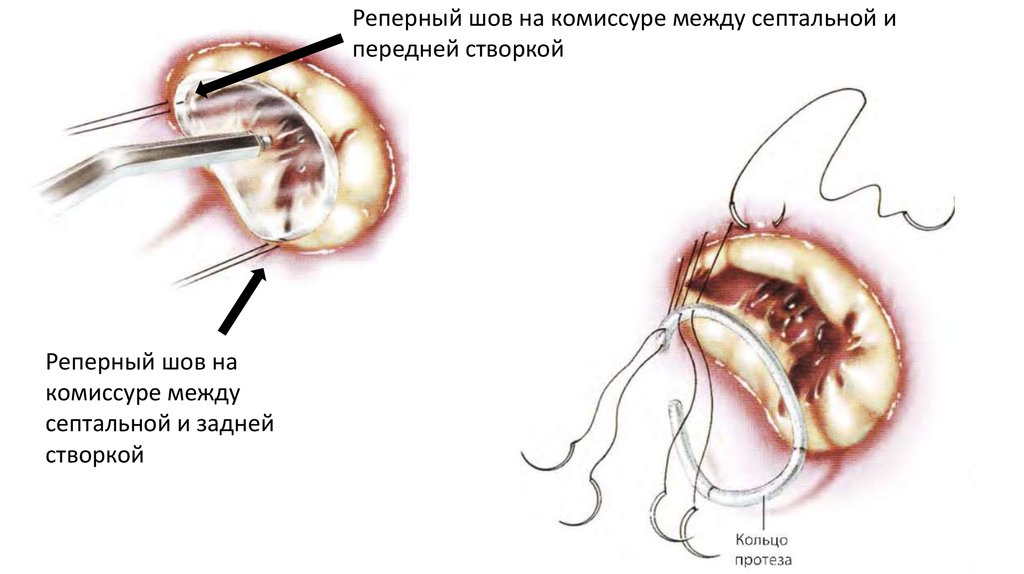 Пластика трикуспидального клапана