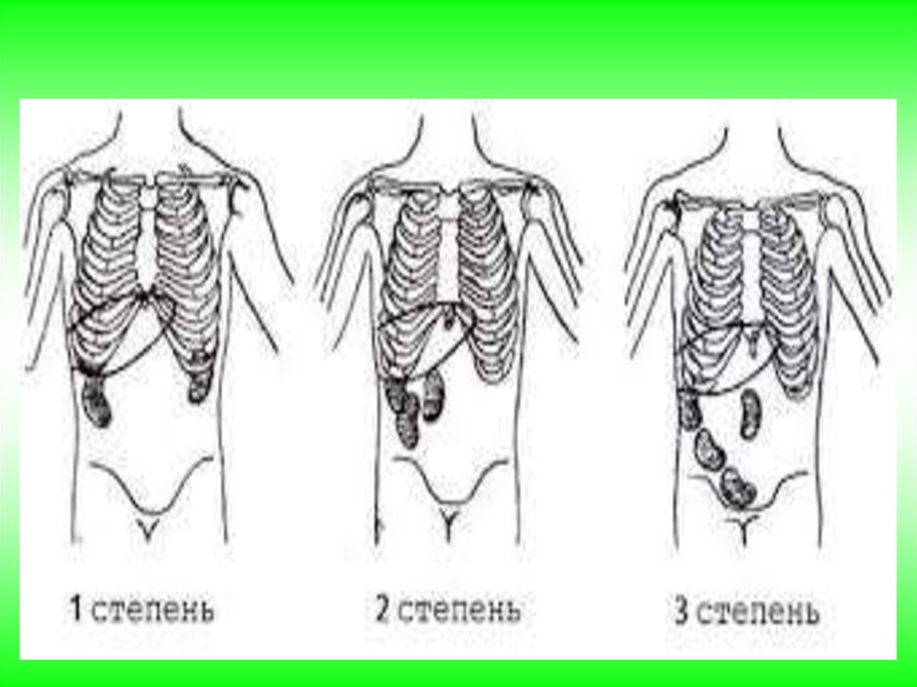 Нефроптоз левой. Нефроптоз почек 3 степени. Опущение почки 3 степени. Нефроптоз 2 степени правой почки. Нефроптоз 1 степени правой.