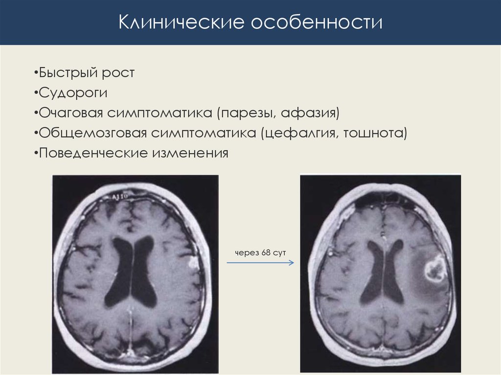 Глиобластома почему толстеют