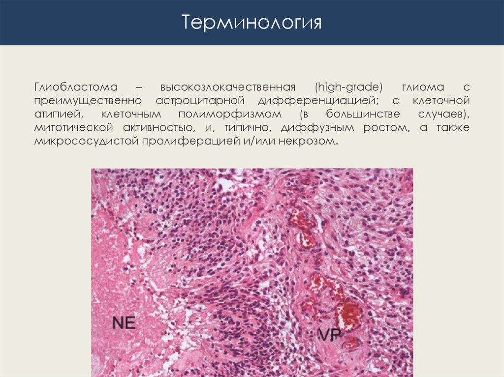 Глиобластома микропрепарат рисунок