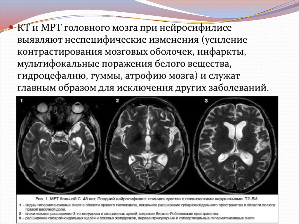 Резидуальные изменения головного. Мультифокальное поражение головного мозга мрт. Кт головного мозга при сифилисе. Нейросифилис Гумма головного мозга. Нейросифилис по мрт головного мозга.