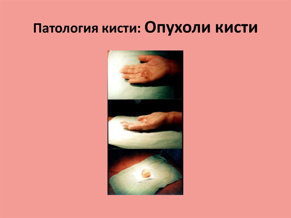 Патология кисти: Опухоли кисти