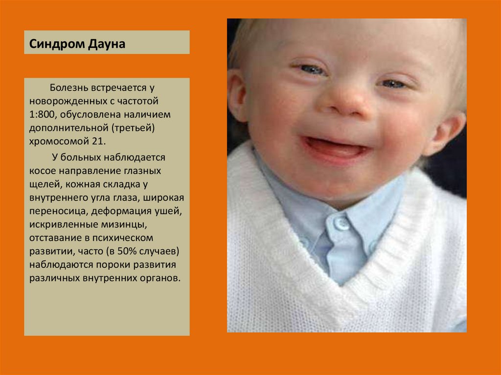 Фенотип ребенка с синдромом дауна. Синдром Дауна. Синдром Дауна у новорождённых. Признаем синдрома Дауна.