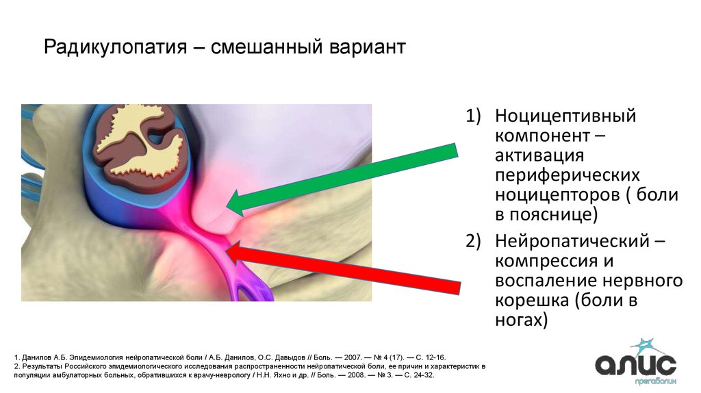 Радикулопатия. Задачи радикулопатия. Постгерпетическая радикулопатия. Радикулопатия f волны. Радикулопатия и тахикардия.