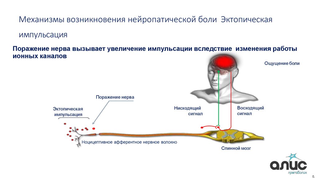 Нейропатическая боль у взрослых