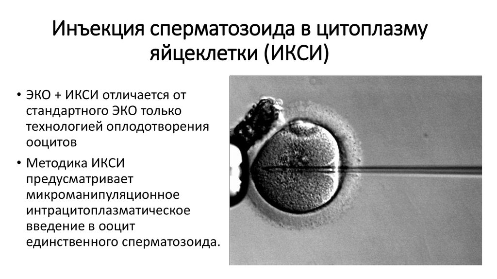 Инъекция сперматозоида в цитоплазму яйцеклетки (ИКСИ)