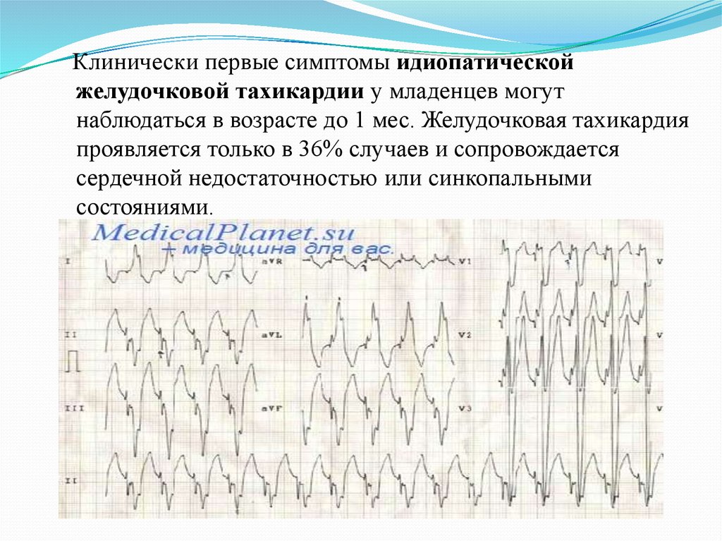 Фото желудочковая тахикардия