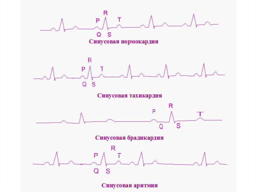 Тахикардия и брадикардия. ЭКГ при аритмии. Синусовая тахикардия с нарушением ритма на ЭКГ. ЭКГ при синусовой аритмии. Синусовая аритмия на ЭКГ.