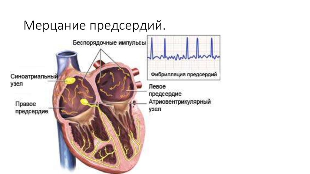 Синусно предсердный узел находится. Мерцание предсердий. Синусно предсердный узел. Фибрилляция сердца. Предсердечное мерцание.