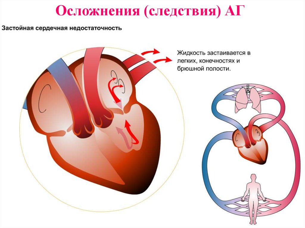 Поражение сердца без застойной сердечной недостаточности. Осложнения артериальной гипертонии. Осложнения гипертонической болезни. Гипертония в слайдах. Застойная сердечная недостаточность.