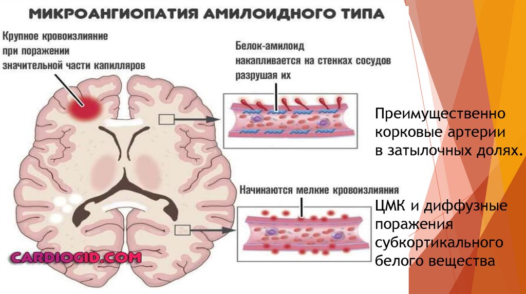 Мозг при деменции