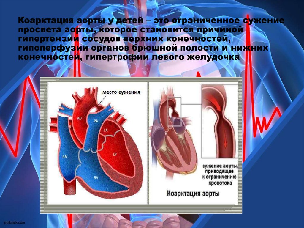 Коарктация аорты фото