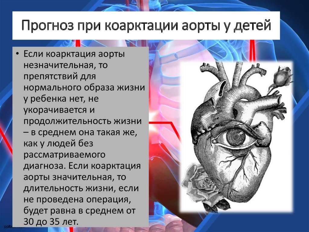 Операция прогноз. Коарктация аорты осложнения. Коарктация аорты у детей осложнения. Осложнения при коарктации аорты.