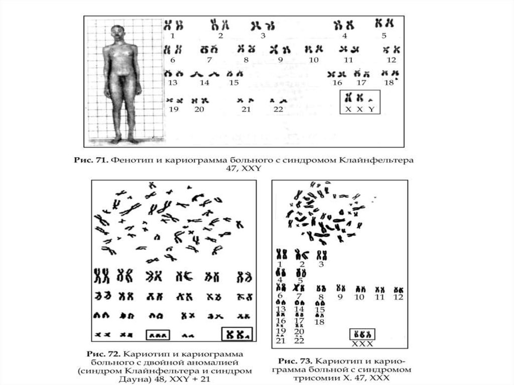 Xxy хромосома. Синдром Клайнфельтера идиограмма. Синдром Клайнфельтера цитогенетический метод. Хромосомный набор больных с синдромом Клайнфельтера. Набор хромосом при синдроме Клайнфельтера.