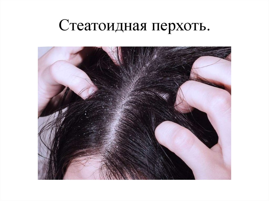 Зуд выпадение волос причины. Фолликулит волосистой части головы. Гнейс на волосистой части головы. Появление на волосистой части головы ггнйса.