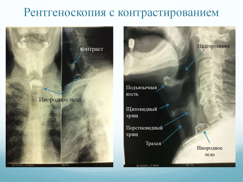 Инородные тела пищевода презентация