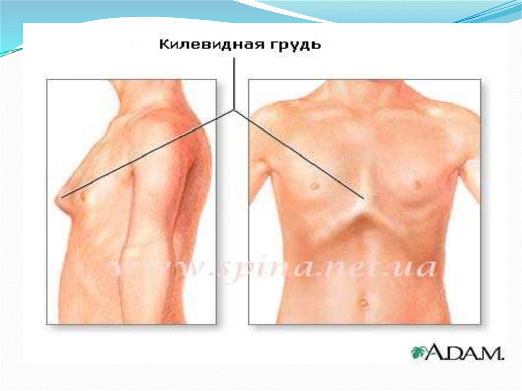 Округлая грудная клетка. Типы килевидной грудной клетки. Синдром Марфана килевидная грудь. Воронкообразная и килевидная деформации. Килеобразная грудная клетка у ребенка.