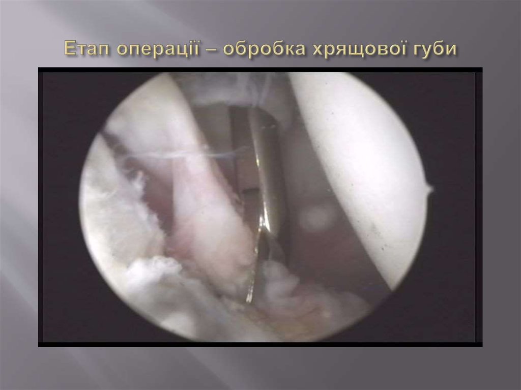 Етап операції – обробка хрящової губи