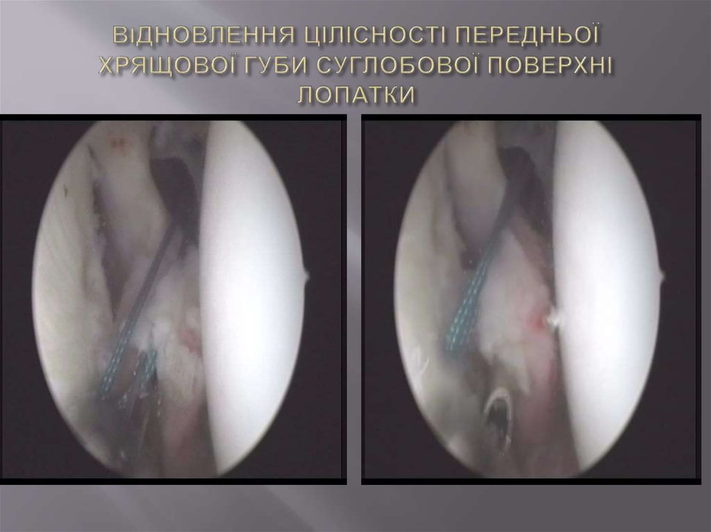 ВІДНОВЛЕННЯ ЦІЛІСНОСТІ ПЕРЕДНЬОЇ ХРЯЩОВОЇ ГУБИ СУГЛОБОВОЇ ПОВЕРХНІ ЛОПАТКИ