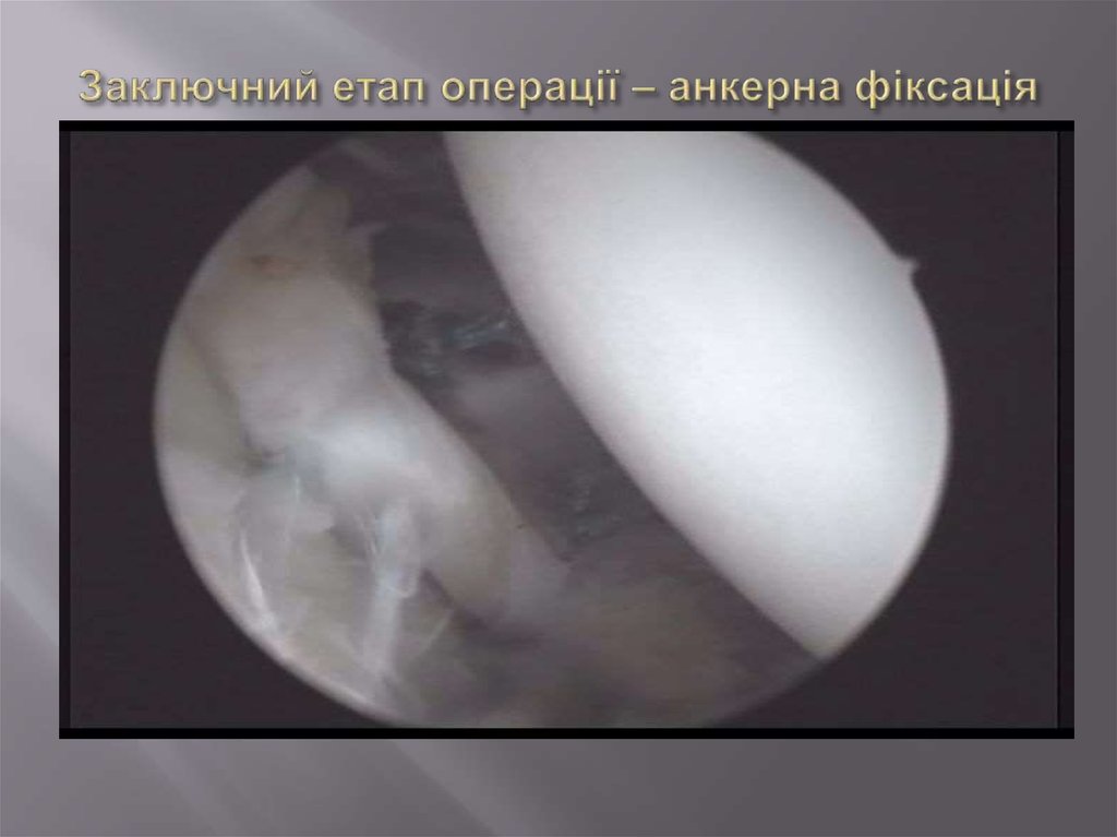 Заключний етап операції – анкерна фіксація