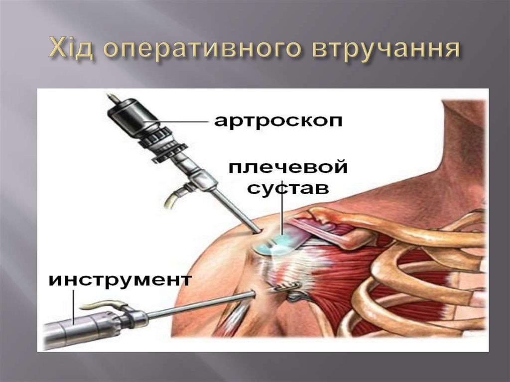 Хід оперативного втручання