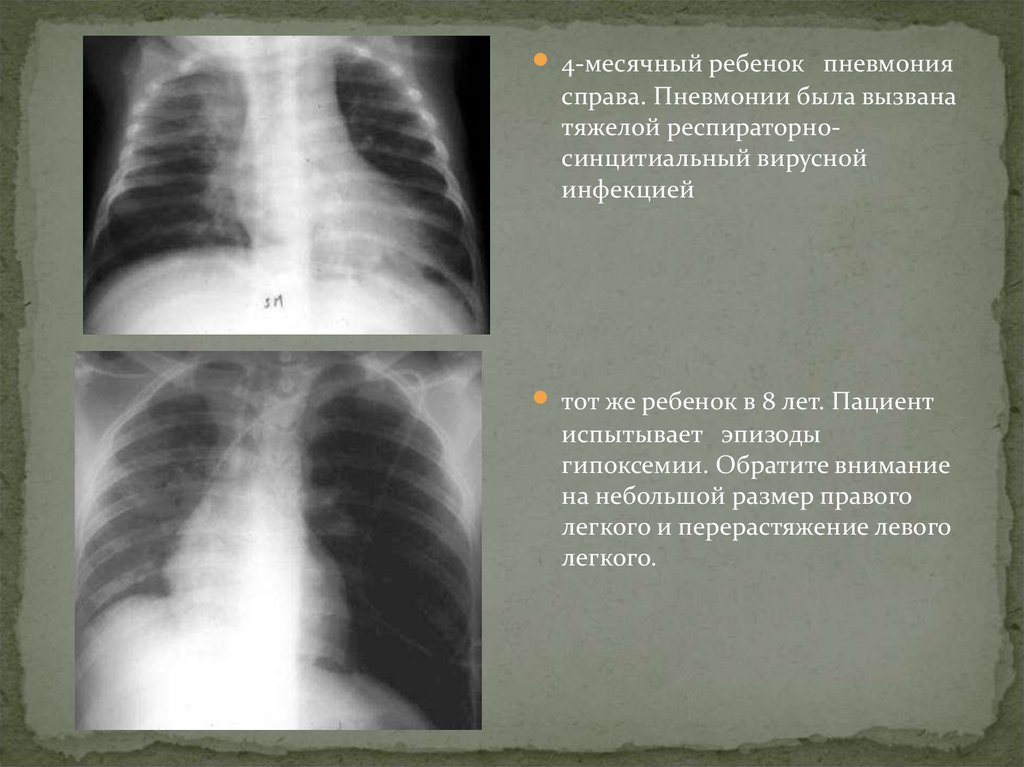 Врожденная лобарная эмфизема клиника рентгенологическая картина принципы лечения