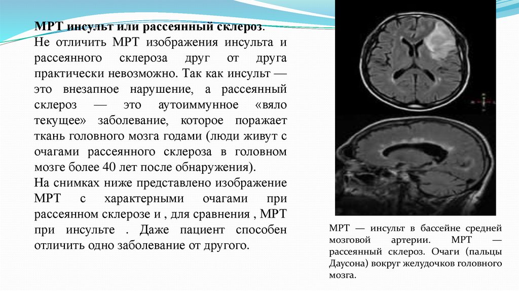 Правосторонний ишемический инсульт головного мозга. ОНМК В бассейне левой средней мозговой. Инсульт в бассейне правой средней мозговой артерии клиника. Ишемический инсульт левой средней мозговой артерии симптомы. Ишемический инсульт в бассейне средней мозговой.