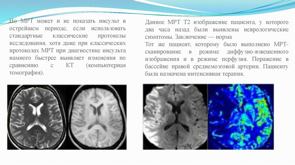 Инсульт клинические рекомендации