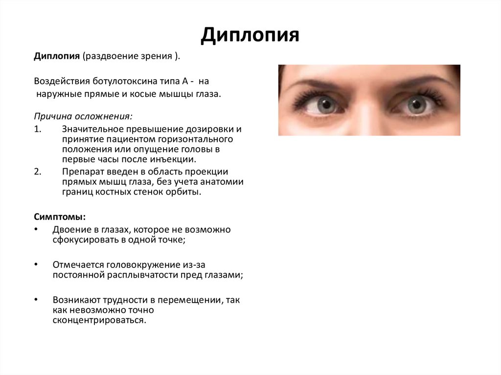 Головокружение двоение в глазах. Диплопия причины неврология. Нарушение зрения диплопия. Двоение в глазах диплопия. Lbgkgbz.