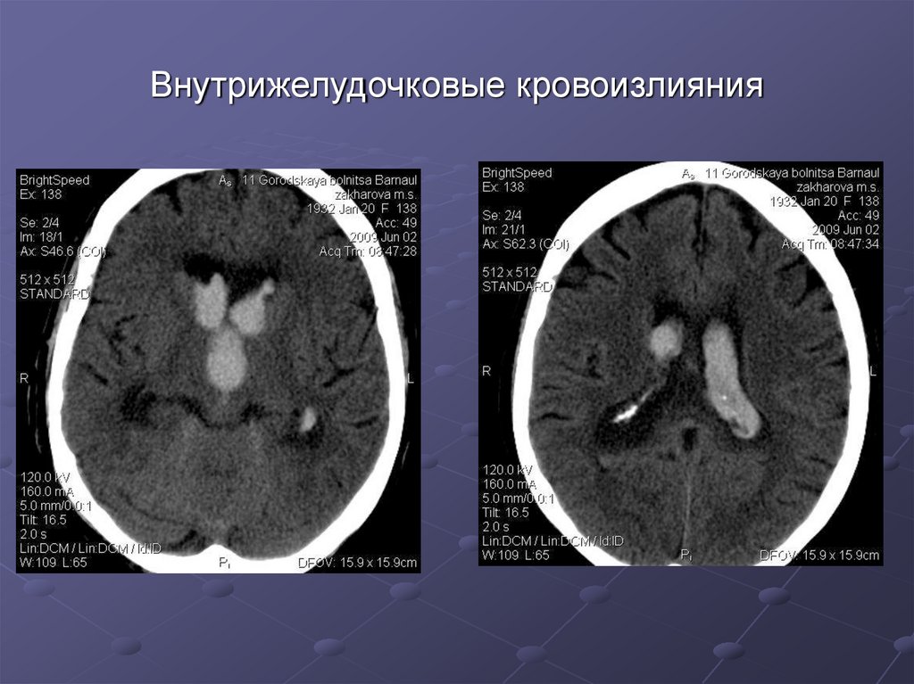 Степени кровоизлияния. Кровоизлияние в желудочки головного мозга кт. Внутрижелудочковая гематома на кт. Внутрижелудочковое кровоизлияние мрт. ВЖК 1 степени у новорожденных симптомы.