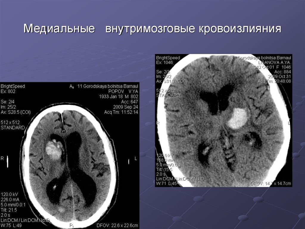 Геморроидальный инсульт последствия. Внутримозговое кровоизлияние. Внутримозговое кровоизлияние кт. Геморрагический инсульт мрт. Медиальная внутримозговая гематома кт.