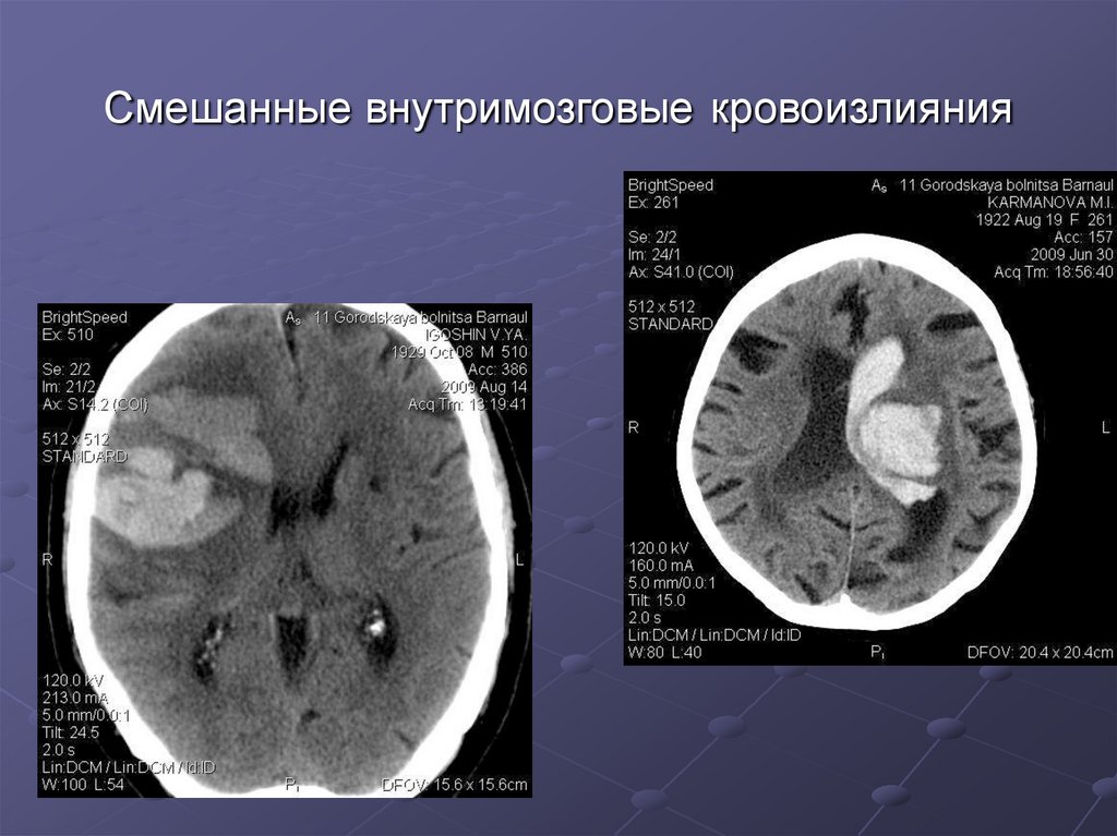 Геморрагический инсульт тесты с ответами