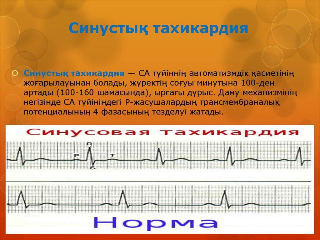 Аритмия и тахикардия. Тахикардия брадикардия аритмия. Тахикардия презентация. Тахикардия и брадикардия одновременно у взрослого. Тахикардия деген не.