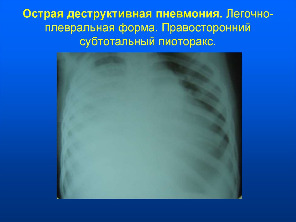 Острая пневмония у детей презентация