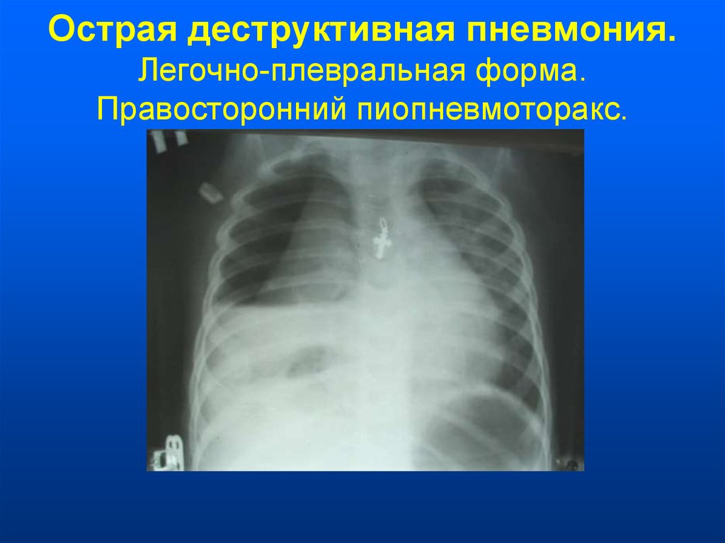 Плевральные осложнения. Пиопневмоторакс рентгенограмма. Легочно-плевральную форму деструктивной пневмонии. Легочное осложнение деструктивной пневмонии. Правосторонний пиопневмоторакс.