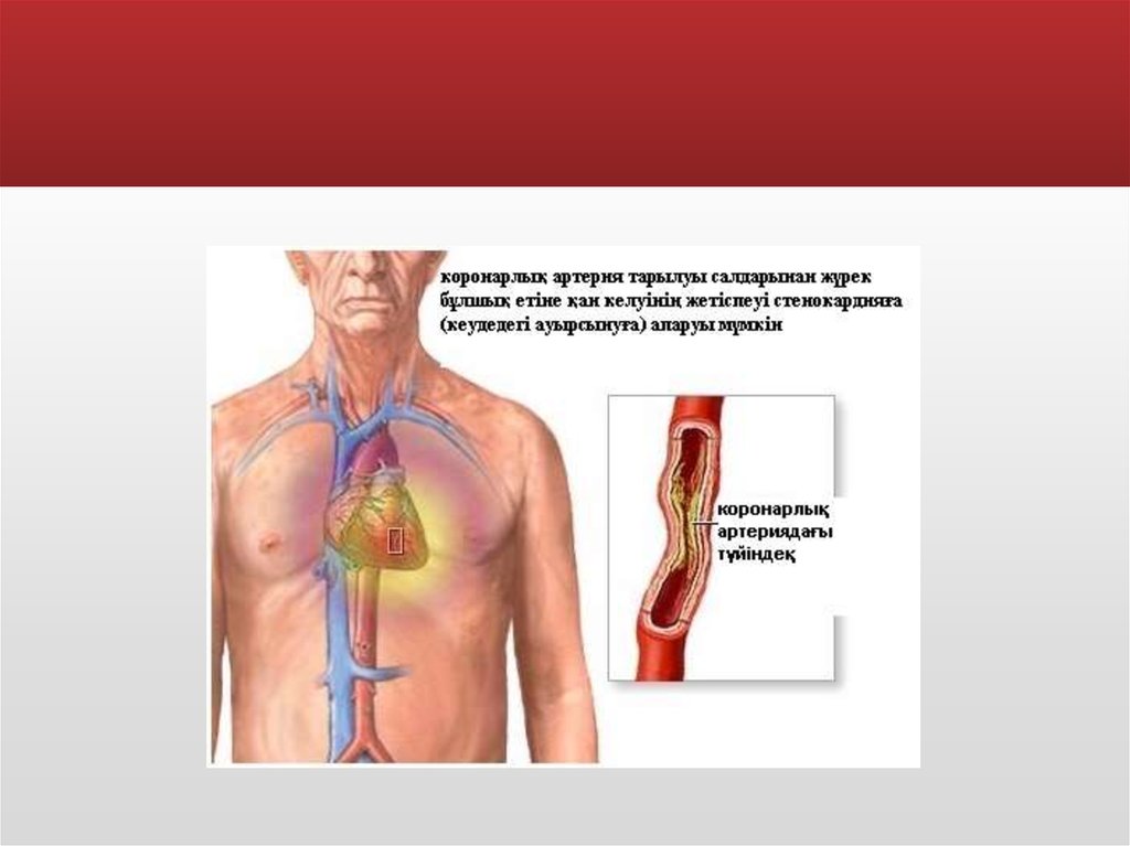 Миокард инфарктісі презентация