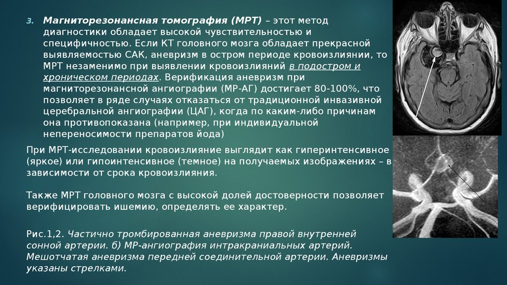 Диагнозы мрт. Аневризма головного мозга мрт. Томография это метод. Аневризма кт или мрт головного мозга.