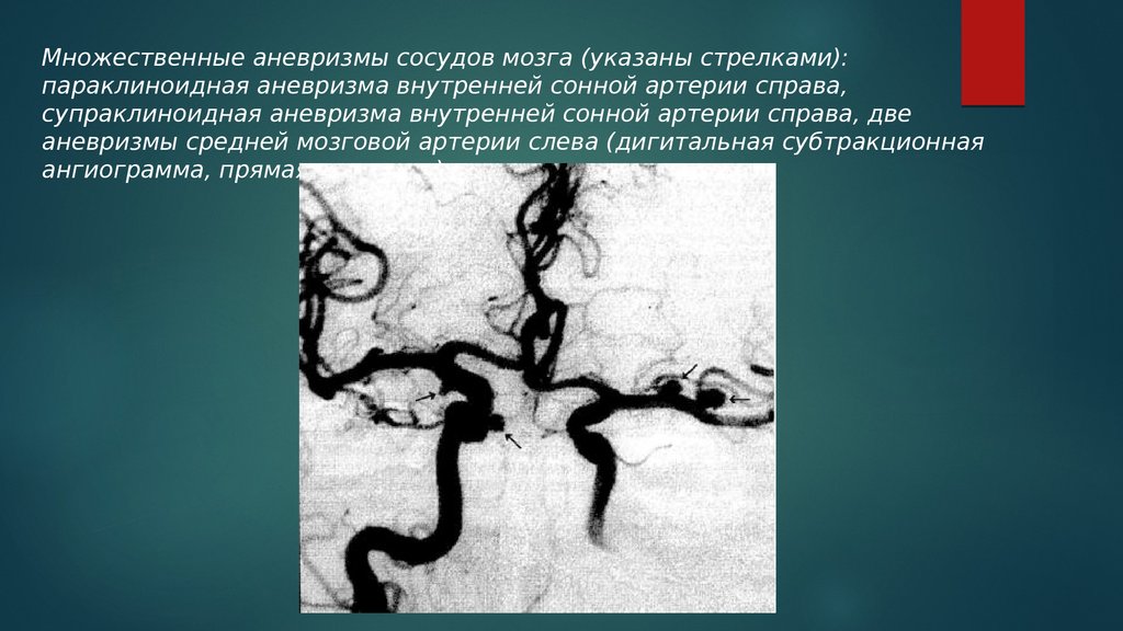 Аневризма сонной артерии что это. Аневризм сонной артерии головного мозга. Аневризма среднемозговой артерии. Аневризма сонной артерии кт. Спраклиноиднаz аневризма.